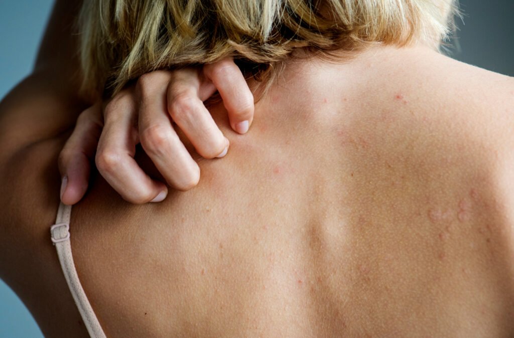 keratosis pilaris