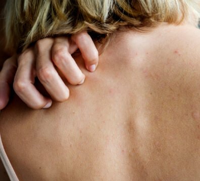 keratosis pilaris