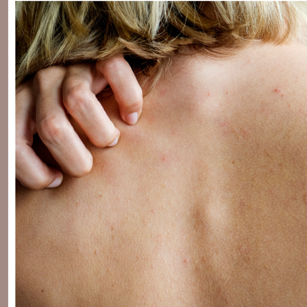 keratosis pilaris