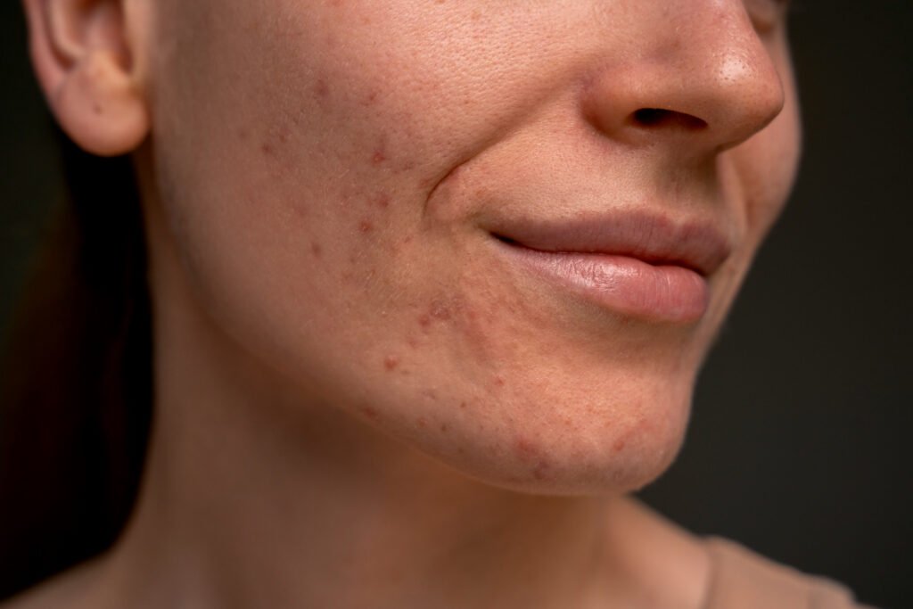 η καλύτερη κρέμα για την ακμή