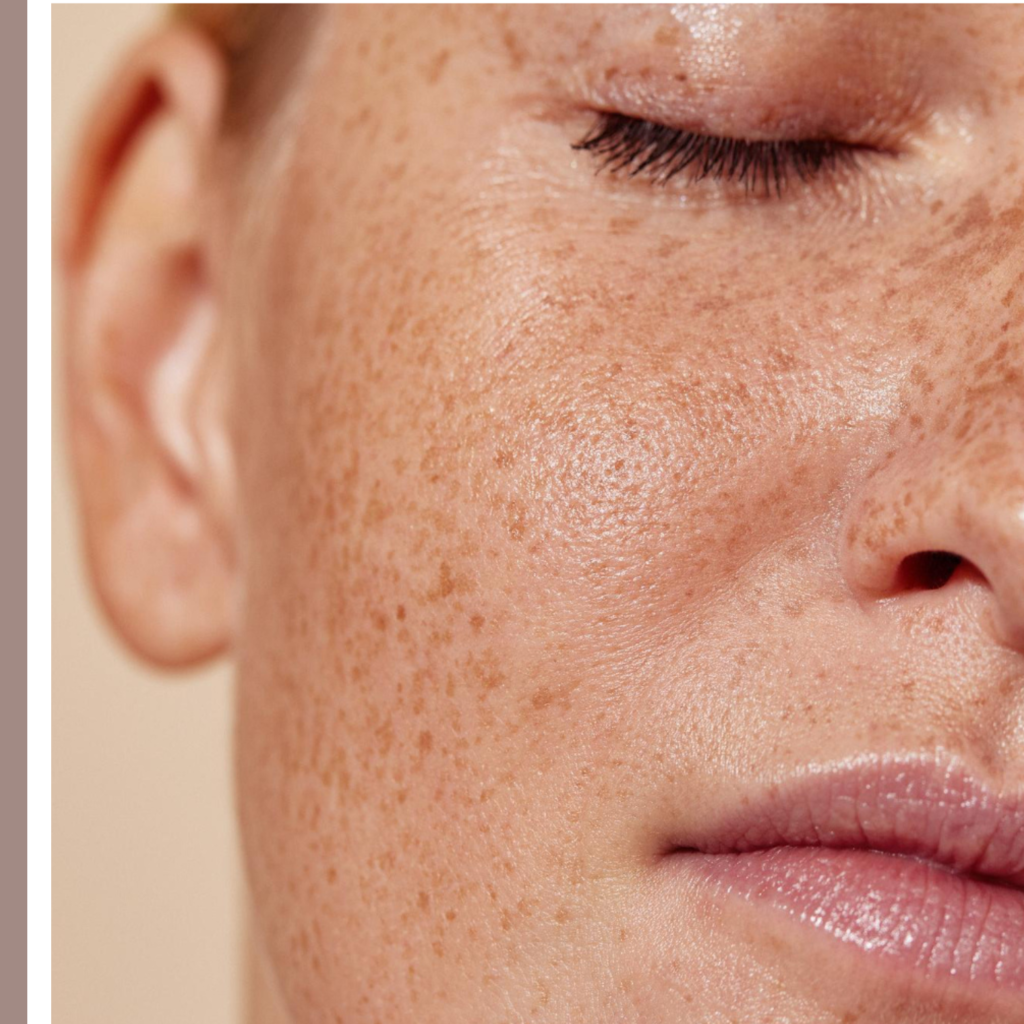 Η καλύτερη κρέμα για πανάδες – Top 3