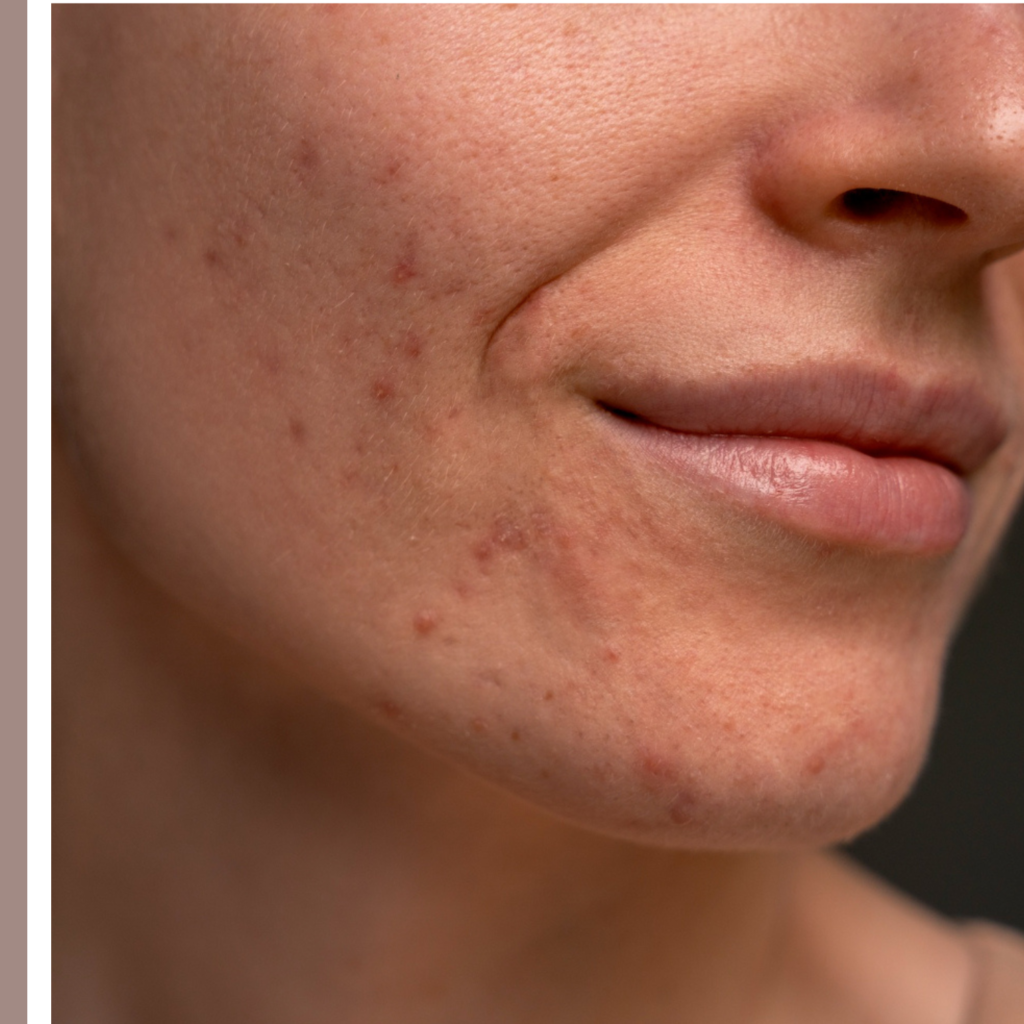 η καλύτερη κρέμα για την ακμή