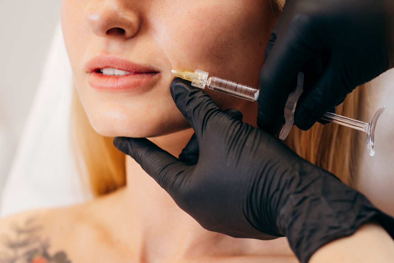 υαλουρονικό