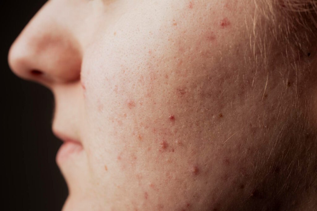 πώς φεύγουν τα σημάδια από σπυράκια