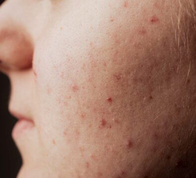 πώς φεύγουν τα σημάδια από σπυράκια