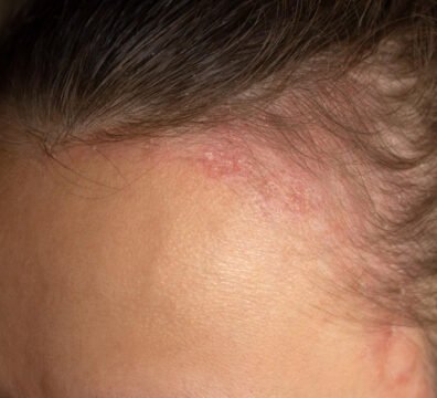 σμηγματορροϊκή δερματίτιδα