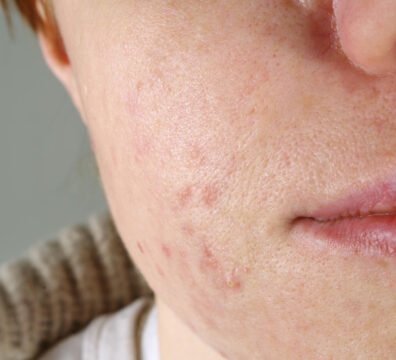 κρέμα για σημάδια ακμής