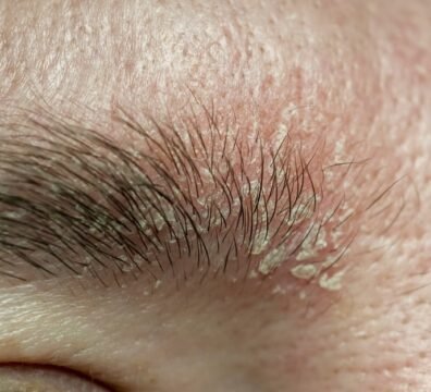 τι είναι η σμηγματορροϊκή δερματίτιδα