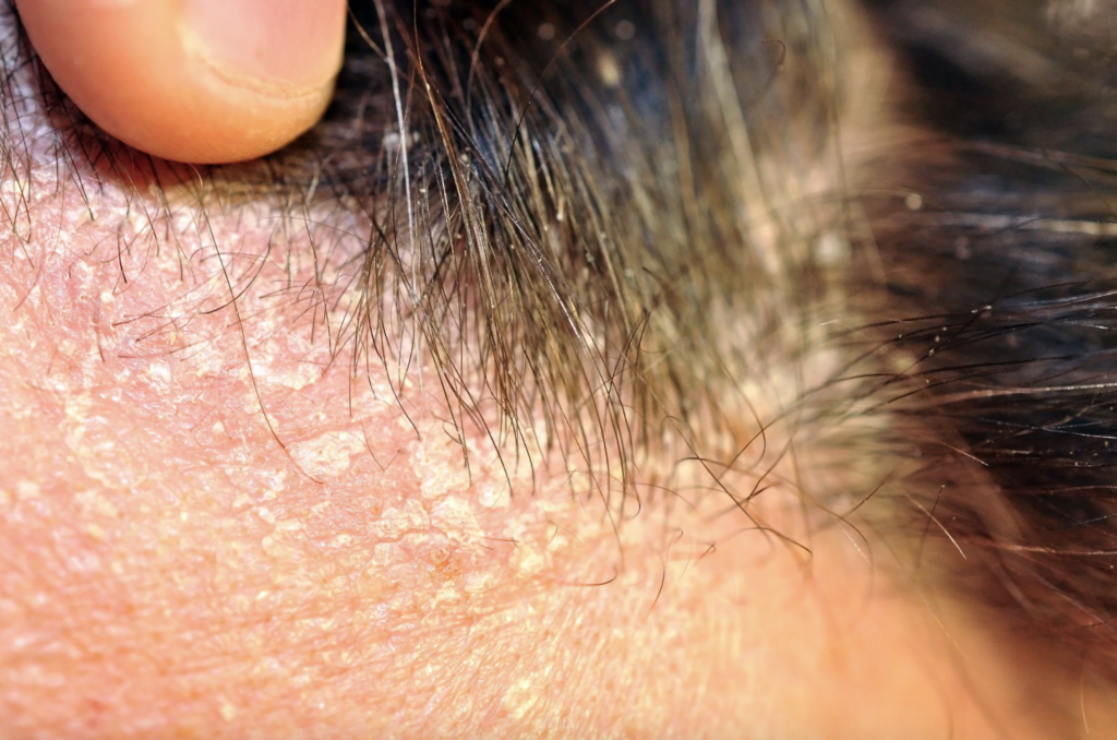 σμηγματορροϊκή δερματίτιδα αίτια