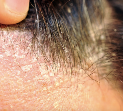 σμηγματορροϊκή δερματίτιδα αίτια