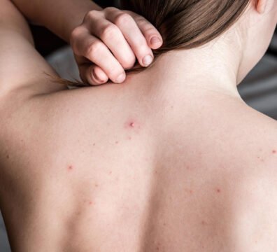 ακμή στην πλάτη