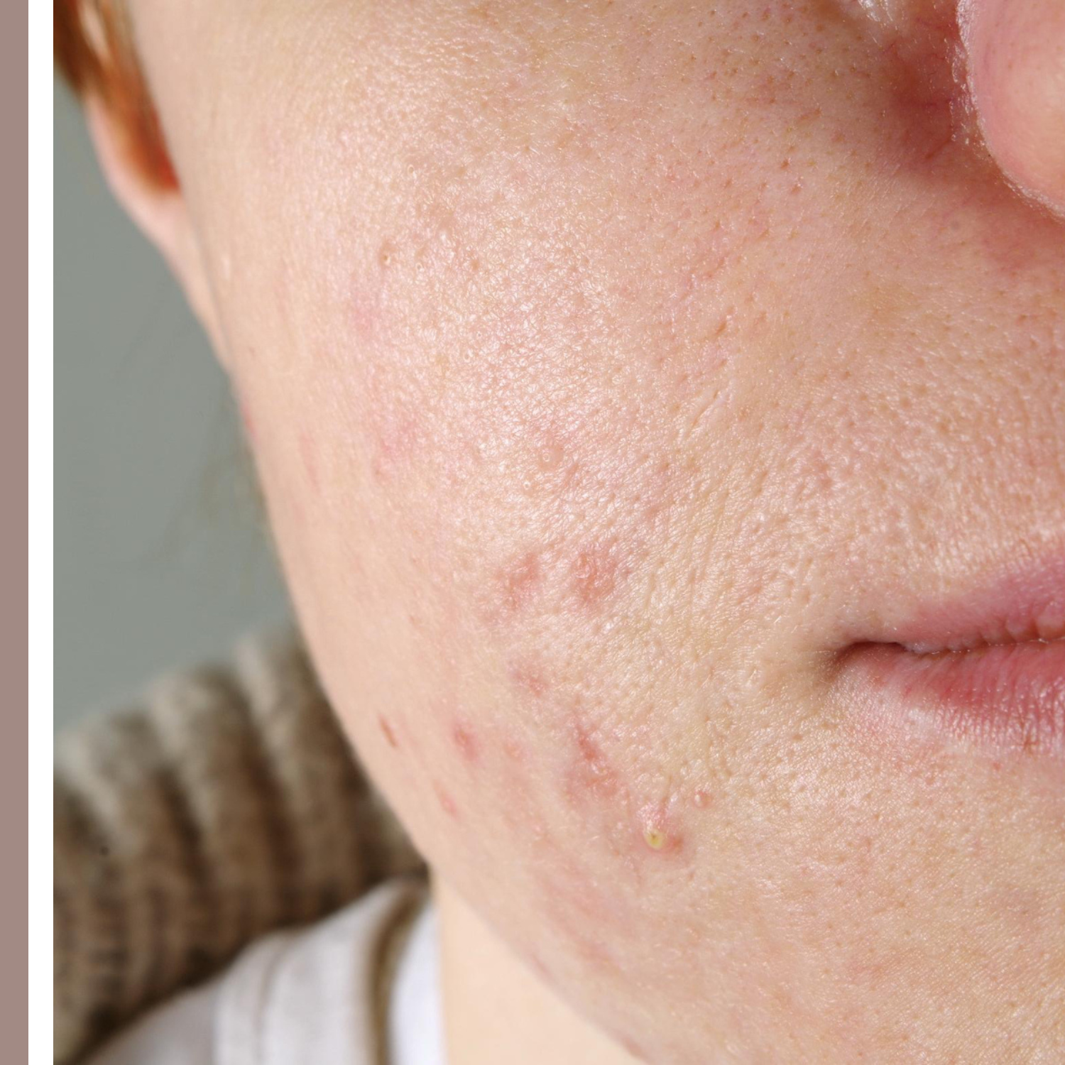 κρέμα για σημάδια ακμής