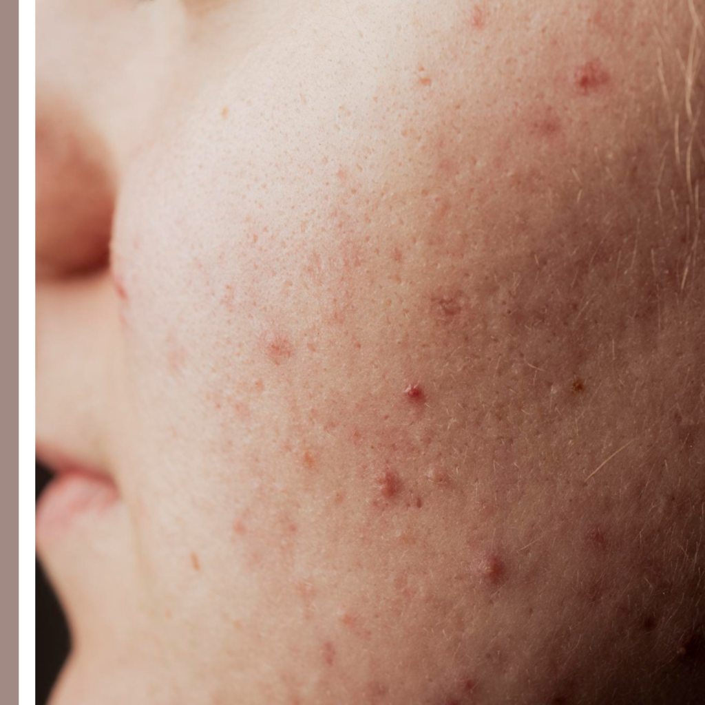 πώς φεύγουν τα σημάδια από σπυράκια