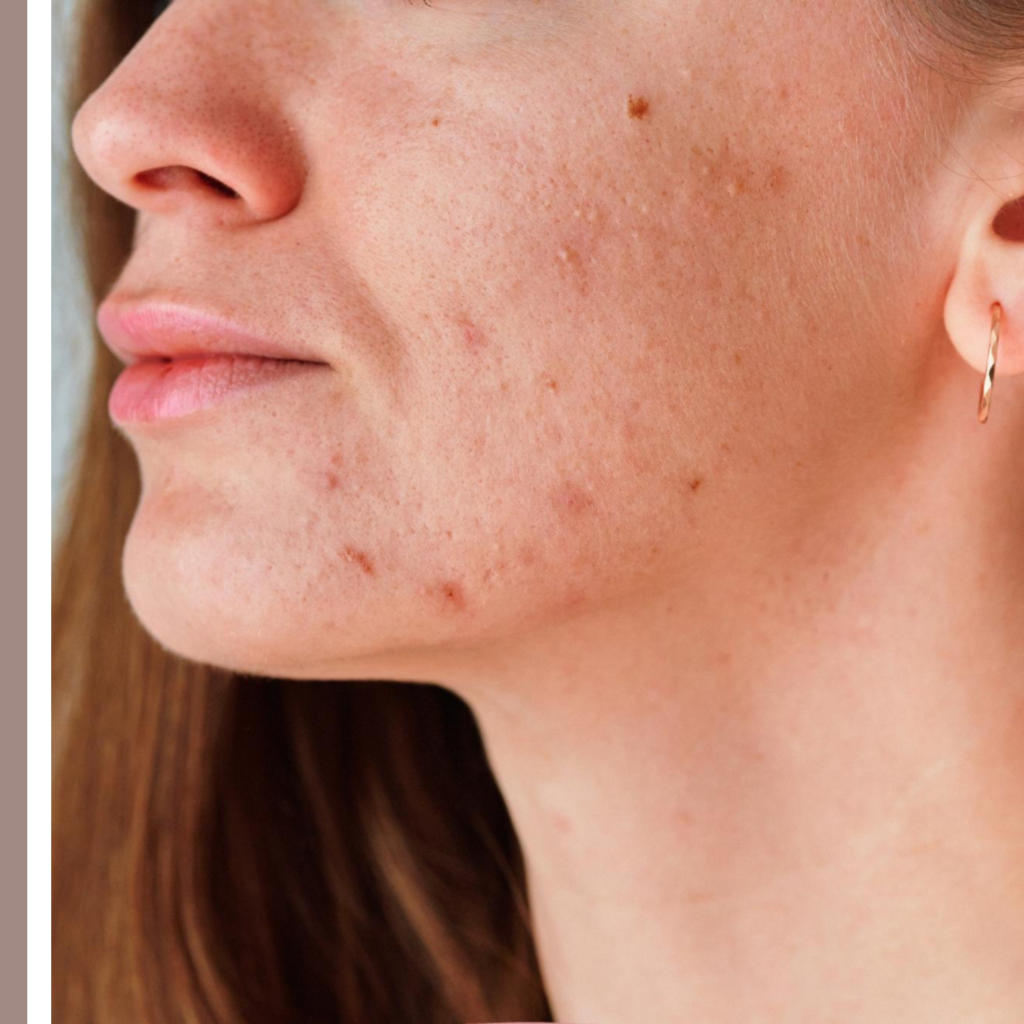 σημάδια ακμής