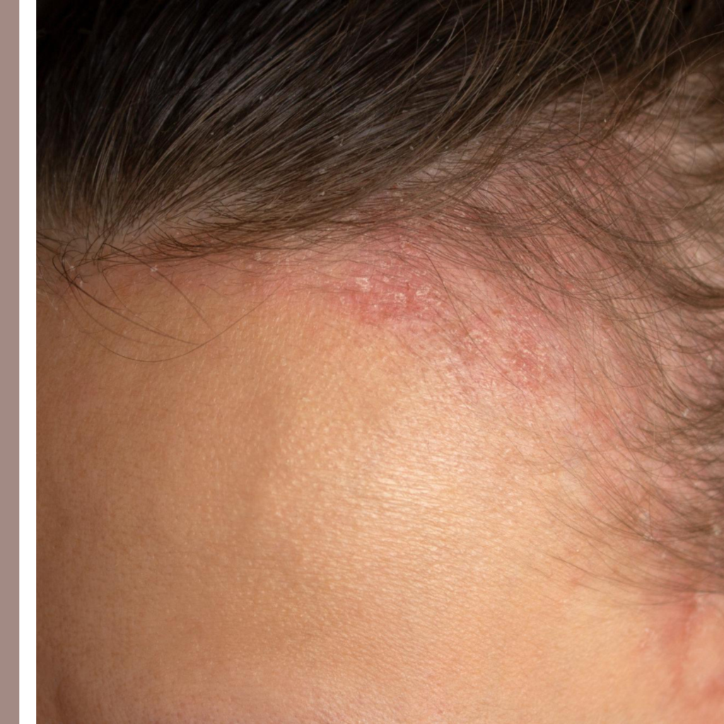 σμηγματορροϊκή δερματίτιδα