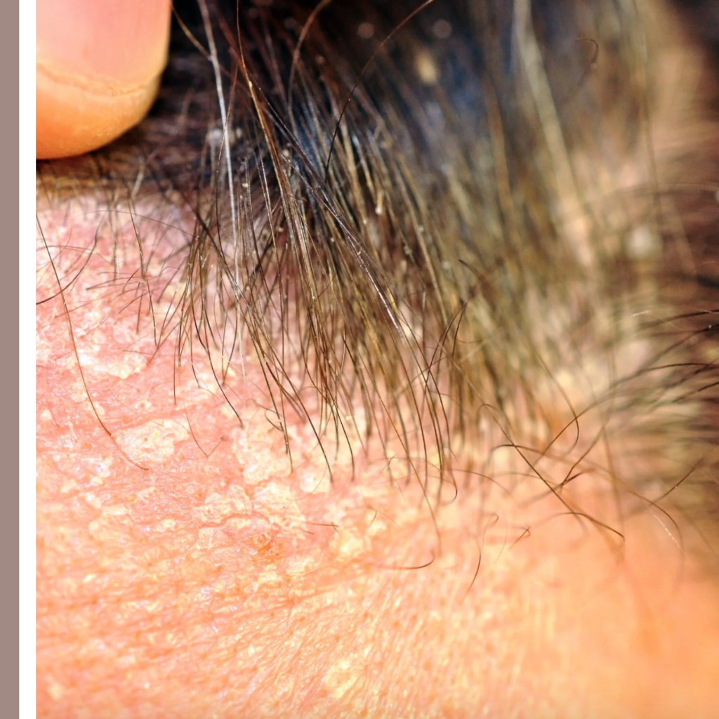 σμηγματορροϊκή δερματίτιδα αίτια