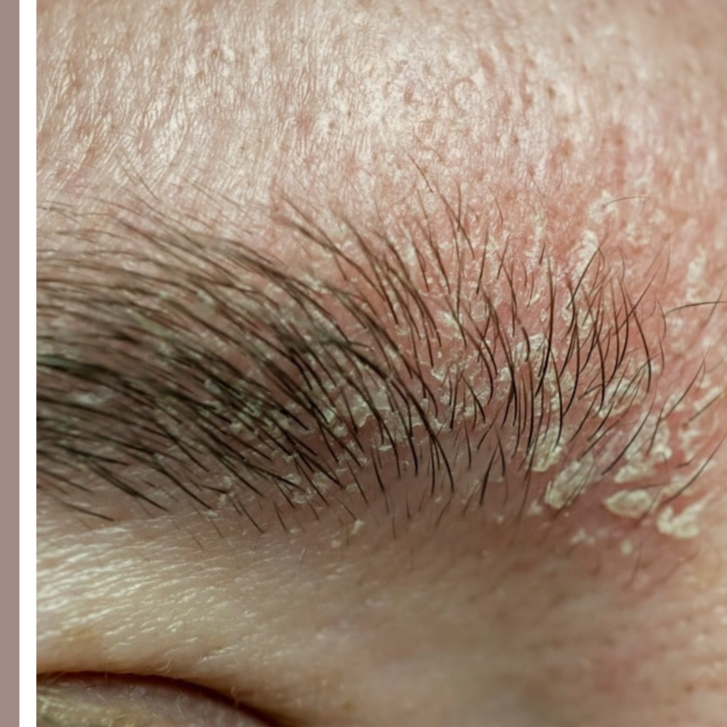 τι είναι η σμηγματορροϊκή δερματίτιδα