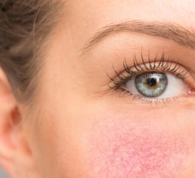 αντηλιακά για ροδόχρου νόσο