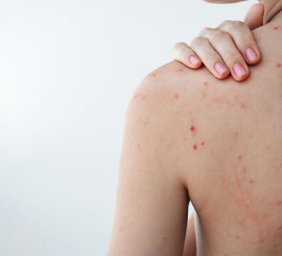 προϊόντα για ακμή στην πλάτη