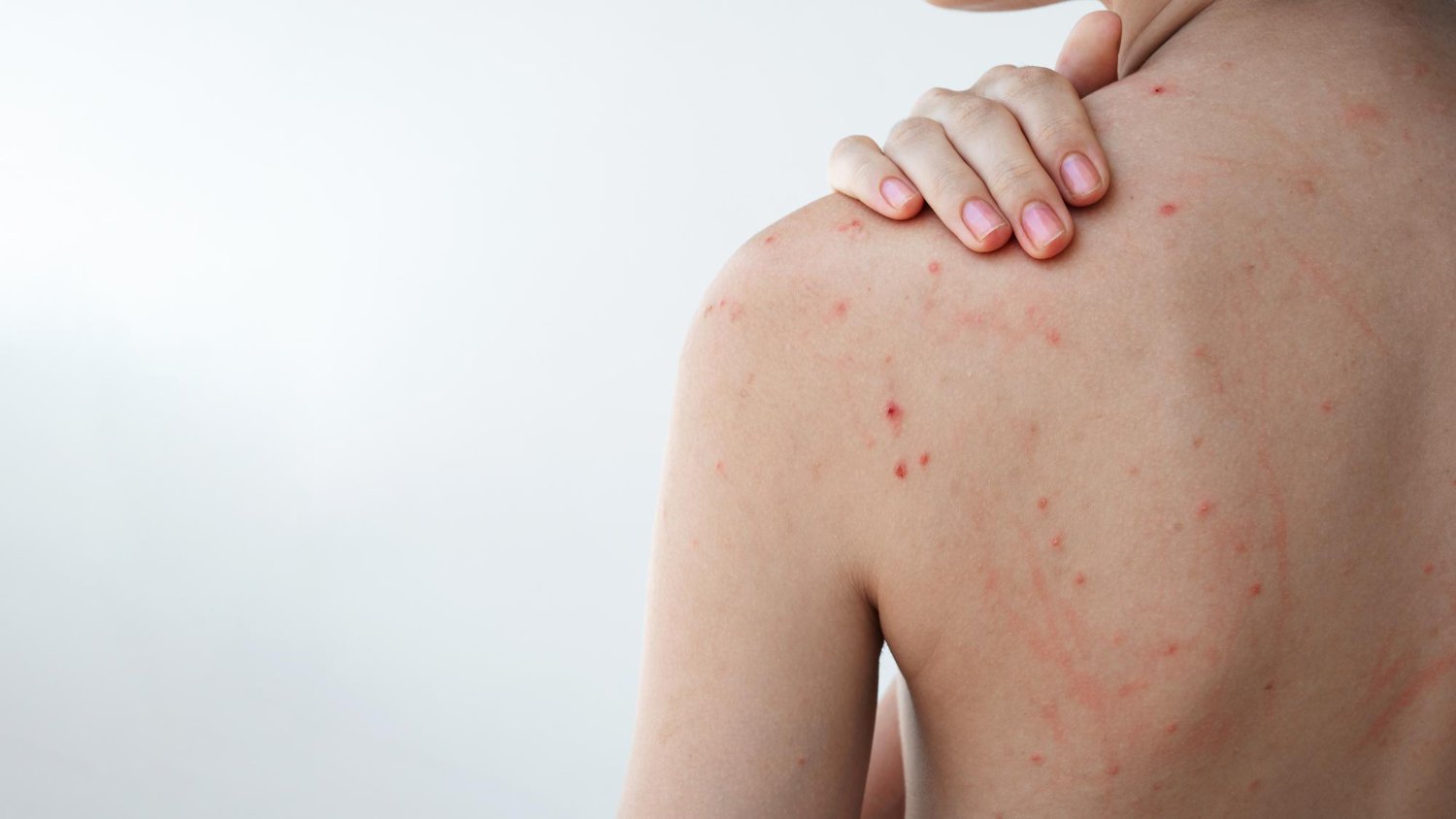 προϊόντα για ακμή στην πλάτη