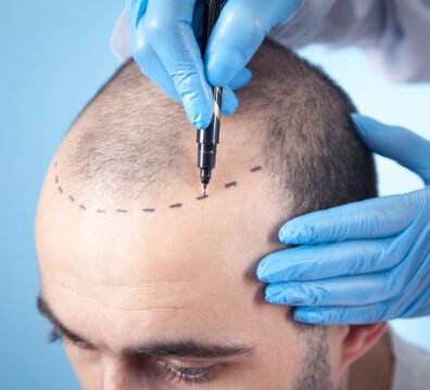 μεταμόσχευση μαλλιών φυσικό αποτέλεσμα