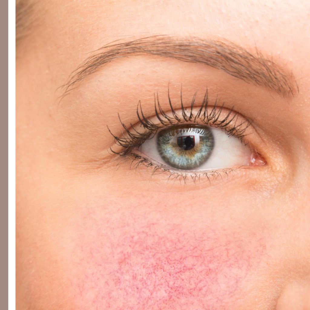 αντηλιακά για ροδόχρου νόσο