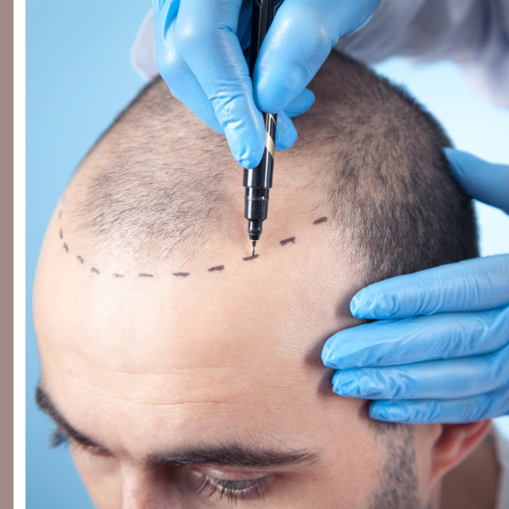 μεταμόσχευση μαλλιών φυσικό αποτέλεσμα