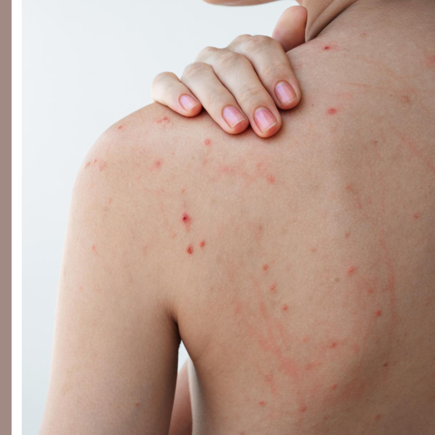 προϊόντα για ακμή στην πλάτη