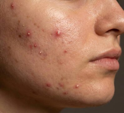 ακμή ενηλίκων