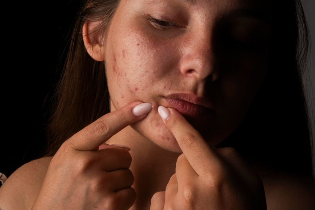 ακμή προσώπου