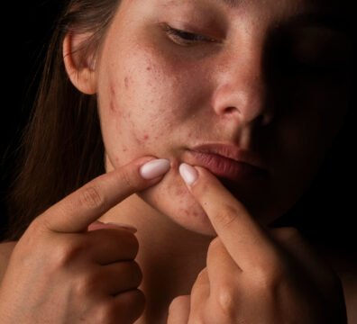 ακμή προσώπου