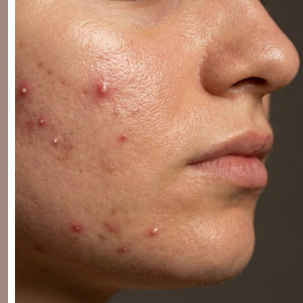 ακμή ενηλίκων