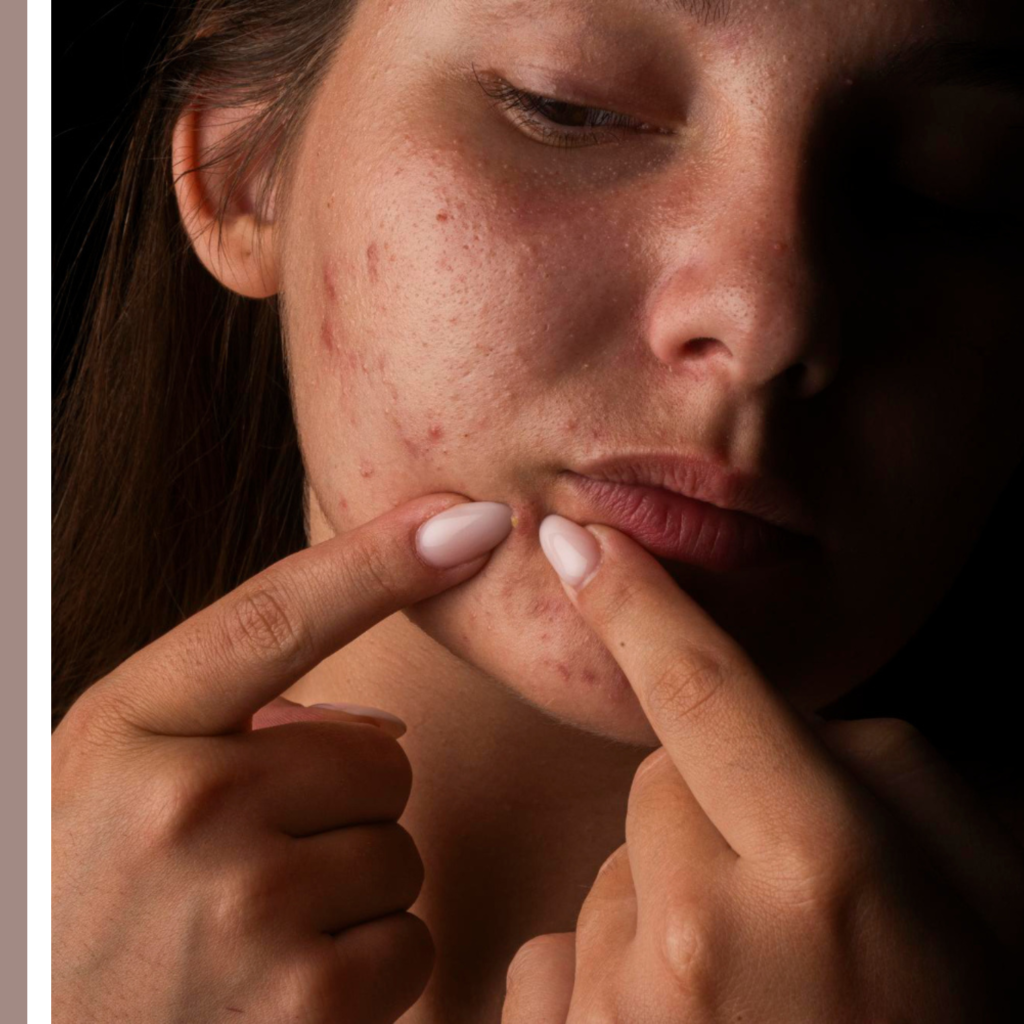 ακμή προσώπου