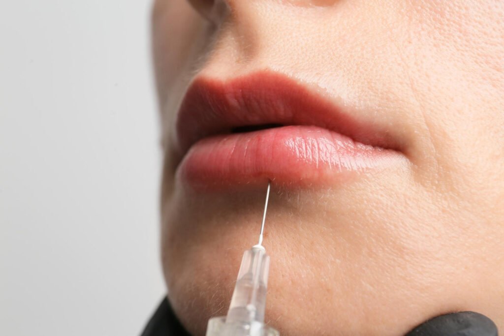 fillers χειλιών
