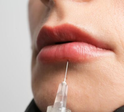 fillers χειλιών