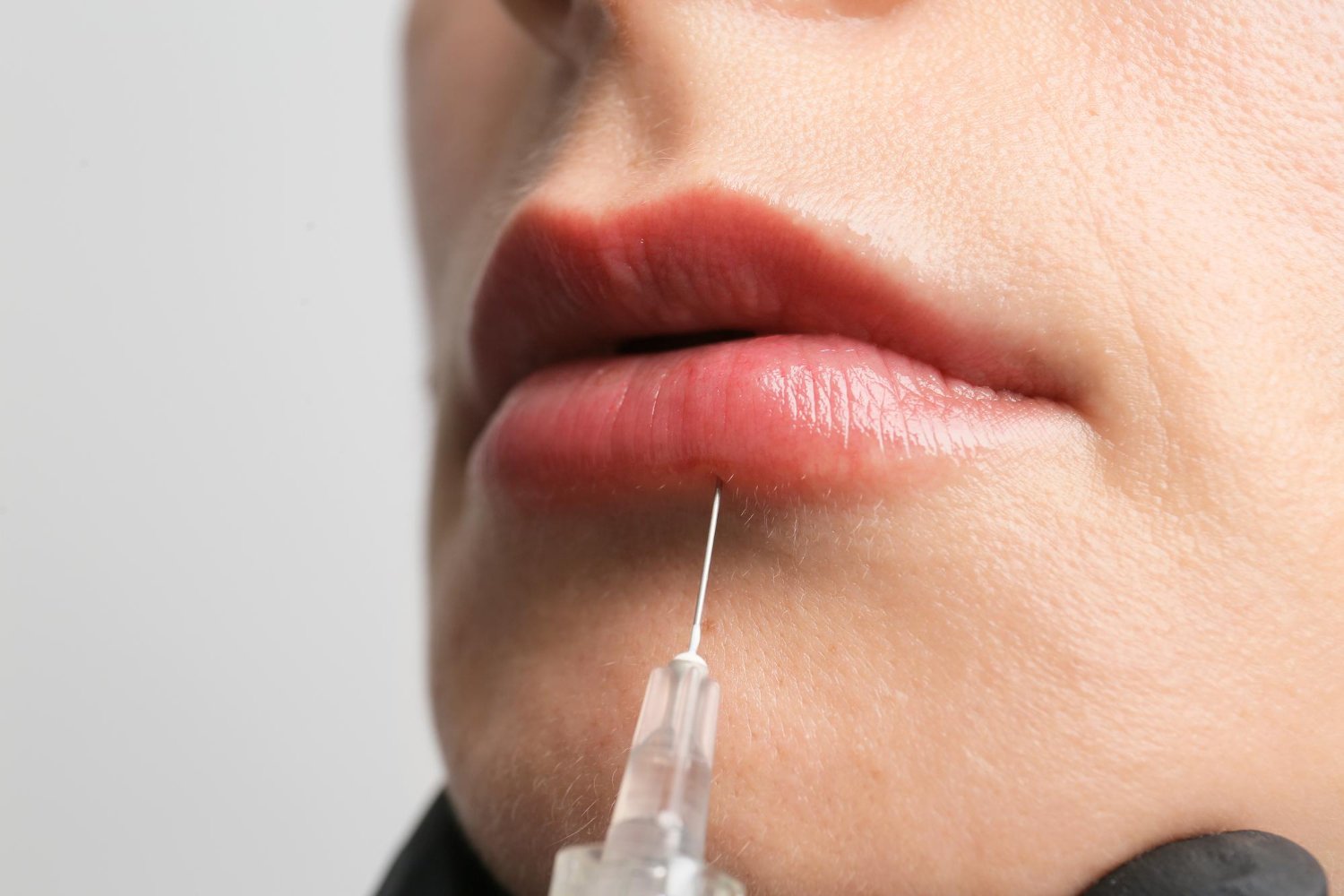 fillers χειλιών