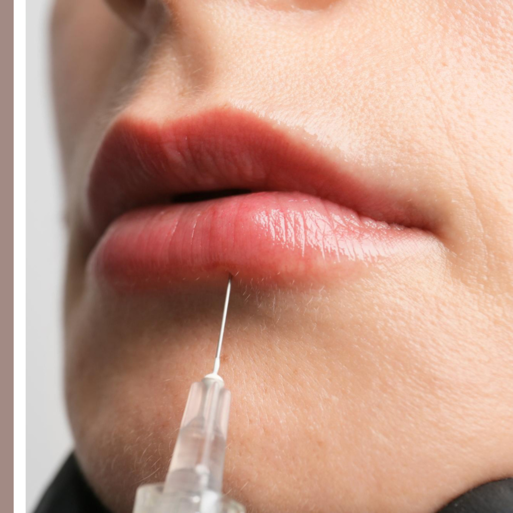 fillers χειλιών