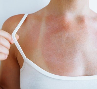τι βάζουμε στο κάψιμο