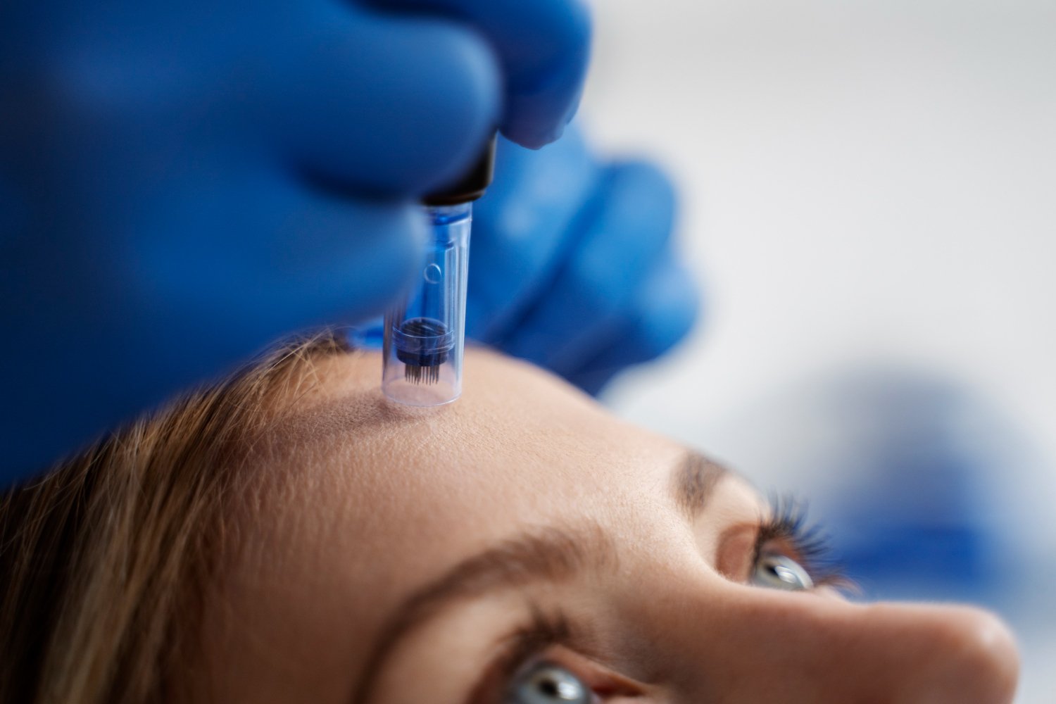 microneedling παρενέργειες