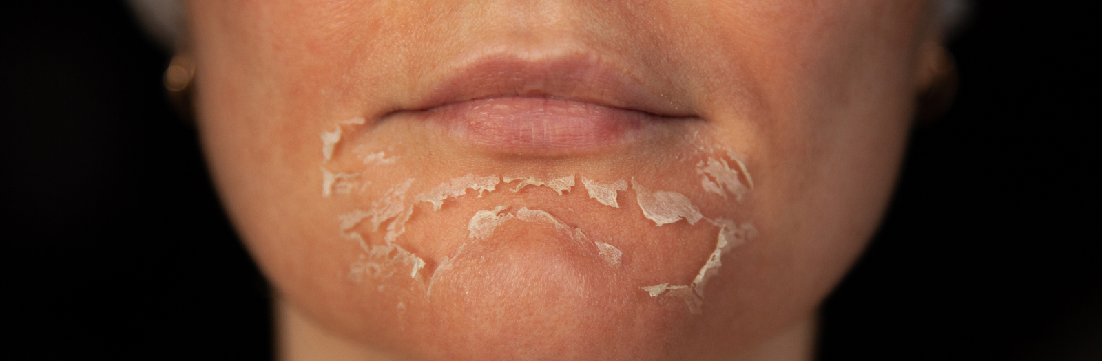 fractional laser ξεφλούδισμα